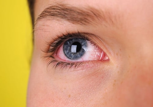 How do you stop eye irritation from fake eyelashes?