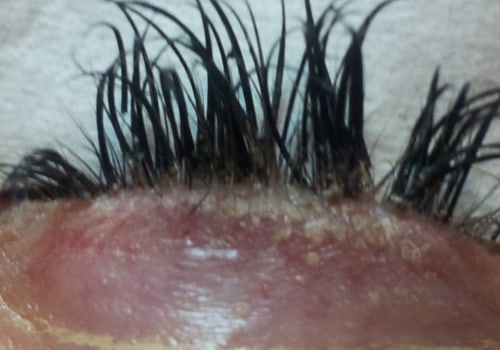 Are eyelash extensions bad long term?