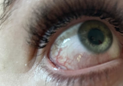 Is it normal for eyes to burn after lash extensions?
